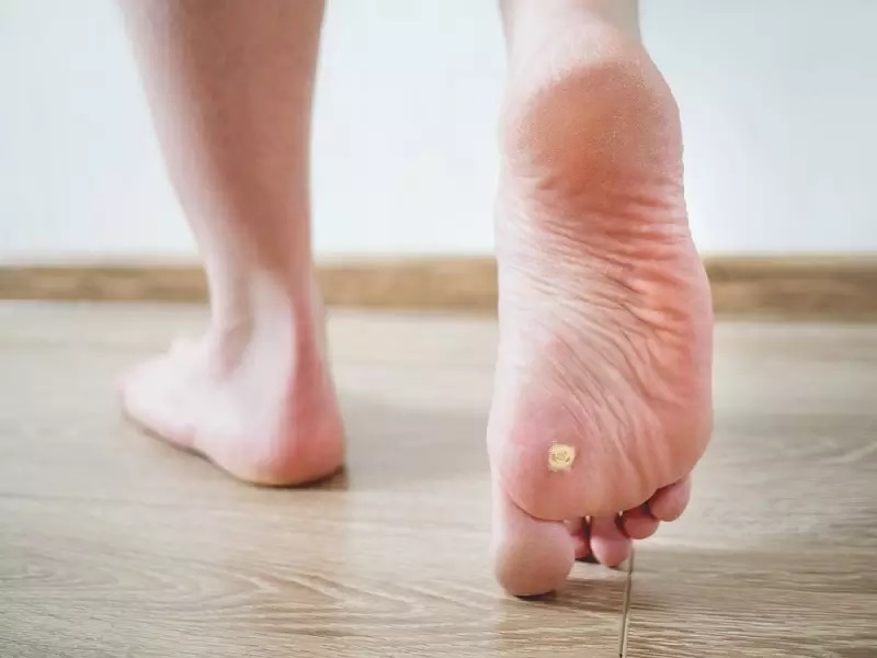 איך אפשר למנוע יבלות בכפות הרגליים?